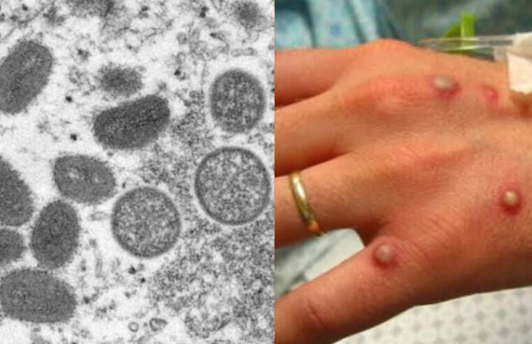 Primeiro caso de varíola dos macacos é confirmado no Amazonas