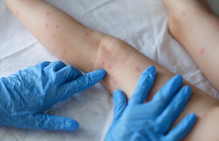 Sobe para 142 o número de casos de varíola dos macacos no Brasil