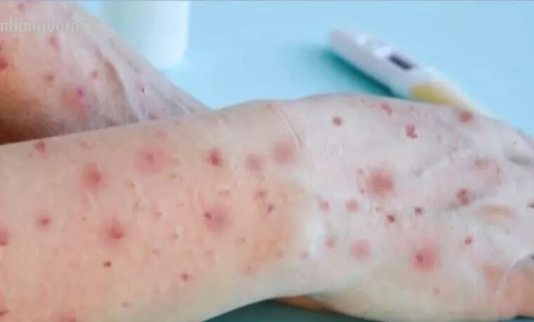 Alerta: Amazonas confirma transmissão local em estado avançado da varíola dos macacos