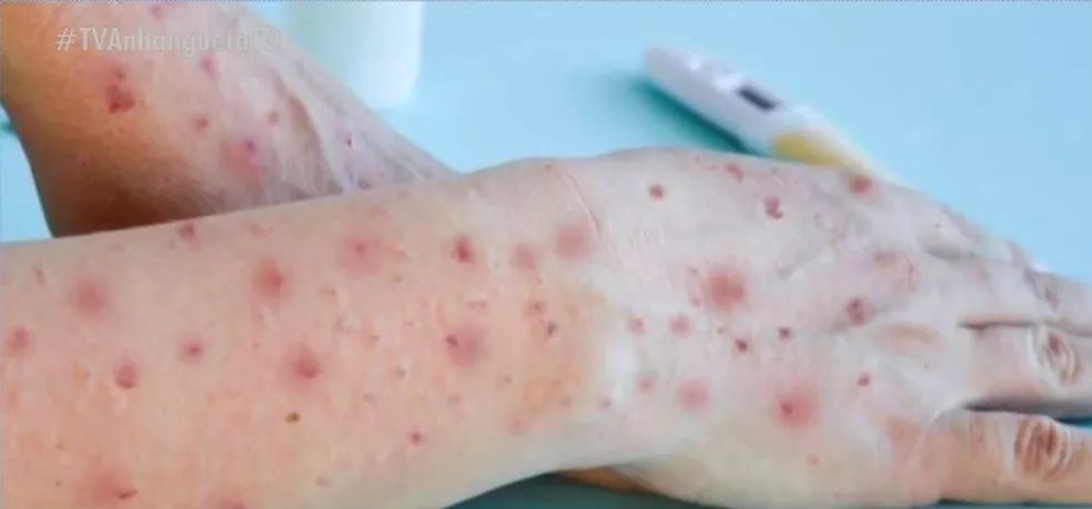 Alerta: Amazonas confirma transmissão local em estado avançado da varíola dos macacos