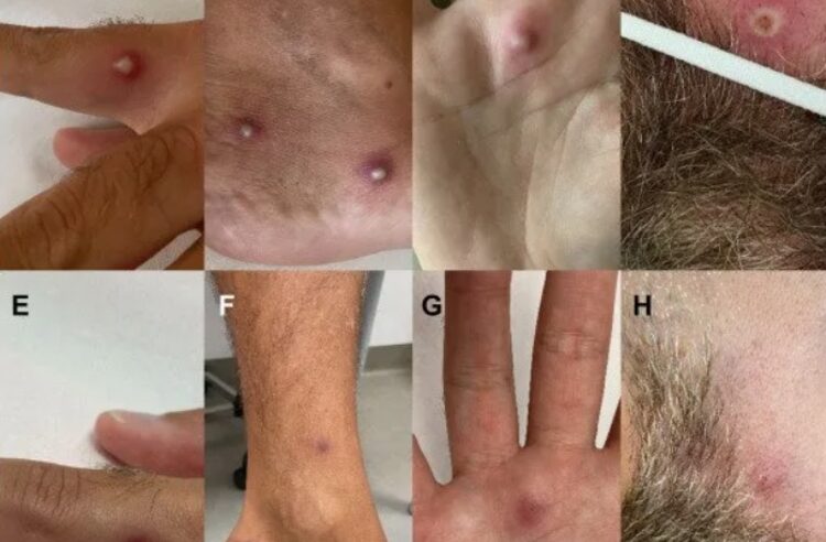 Homem é o 1º do mundo a contrair varíola dos macacos, Covid-19 e HIV ao mesmo tempo