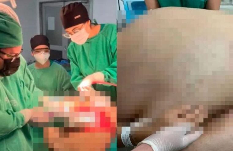 Morre mulher que teve tumor de 46kg retirado em cirurgia de emergência