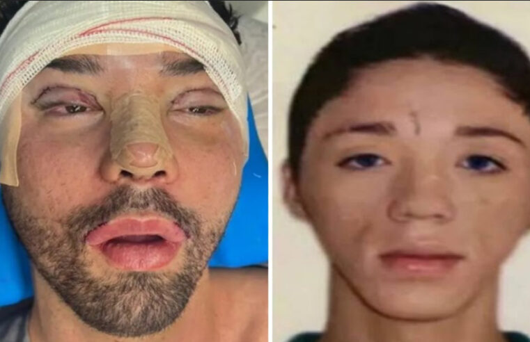 Blogueiro Rico Melquíades desabafa após plástica: ‘Não aguentava mais ser chamado de feio’￼