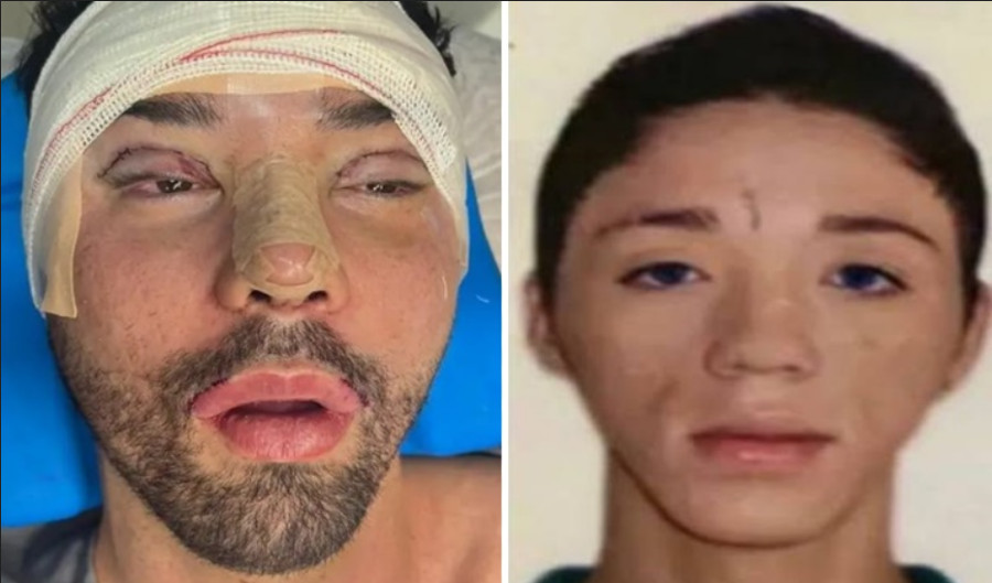 Blogueiro Rico Melquíades desabafa após plástica: ‘Não aguentava mais ser chamado de feio’￼