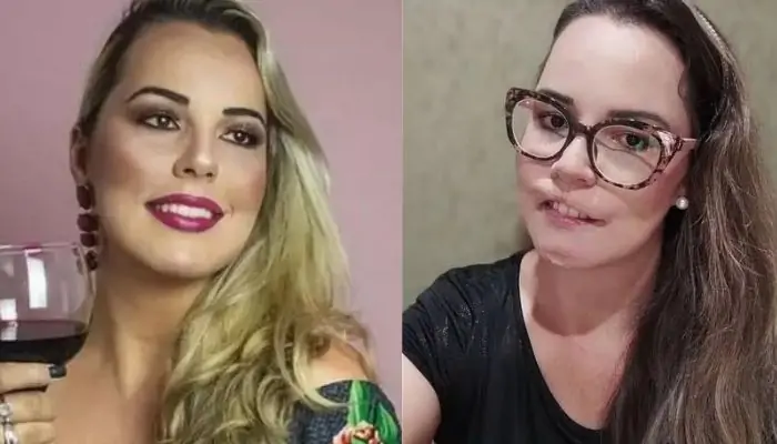 Influencer perde parte da boca e do queixo após fazer preenchimento labial