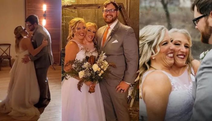 Gêmea siamesa se casa com enfermeiro mesmo unida à irmã