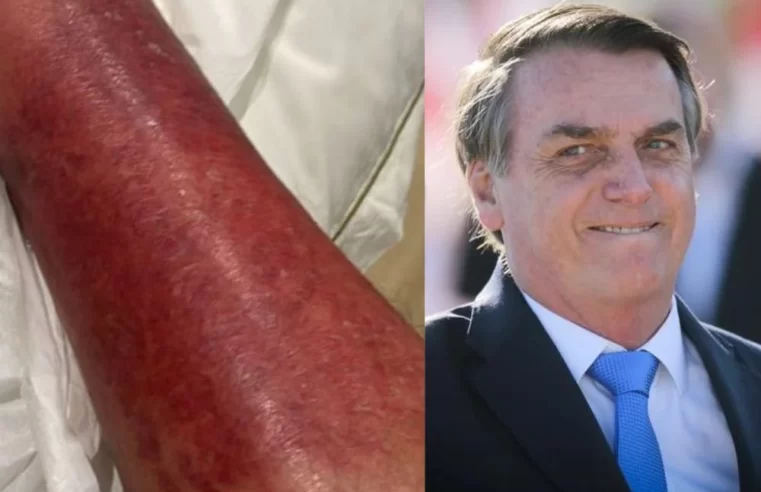 Bolsonaro relata melhora em quadro de erisipela durante internação em São Paulo