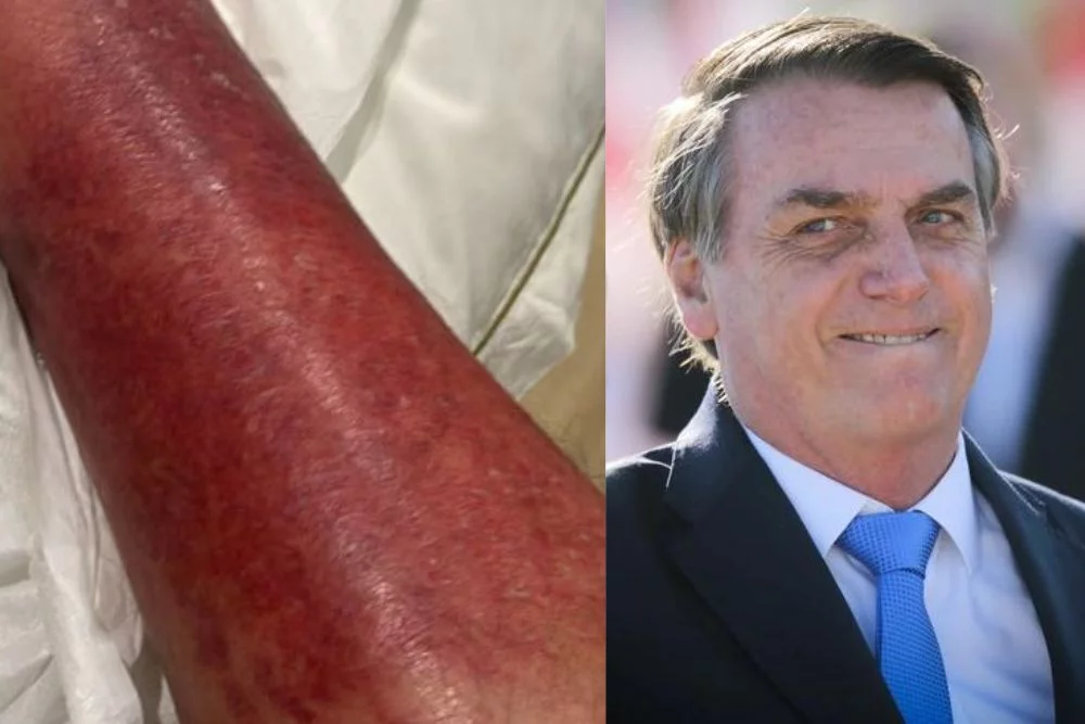 Bolsonaro relata melhora em quadro de erisipela durante internação em São Paulo