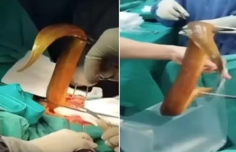 Homem enfia enguia viva no ânus e passa por cirurgia de emergência