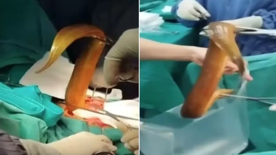 Homem enfia enguia viva no ânus e passa por cirurgia de emergência