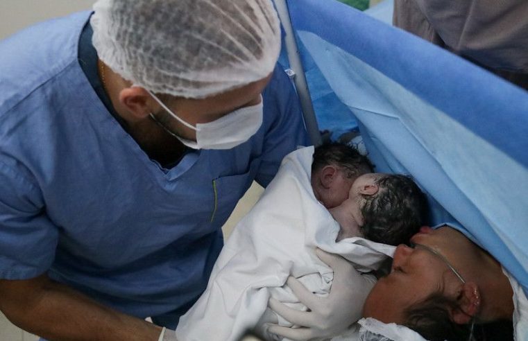 Parto raro de gêmeas siamesas é realizado com sucesso na rede pública de saúde do Amazonas