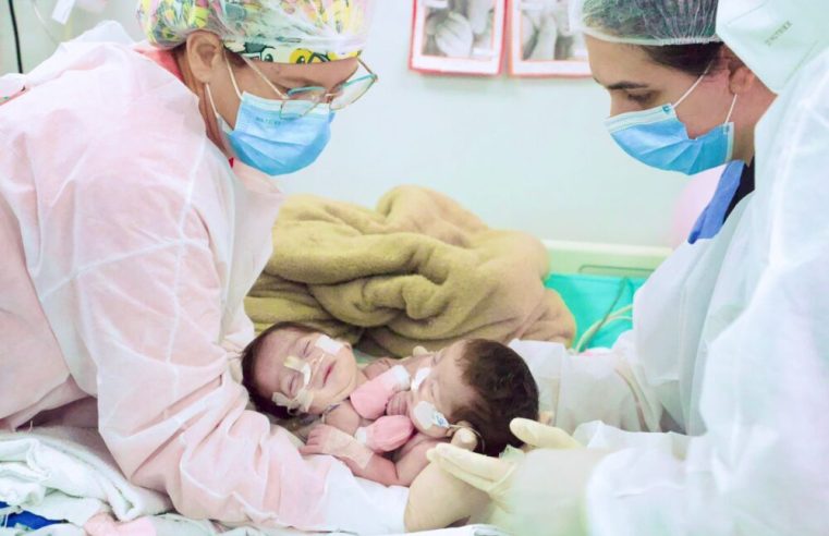 Gêmeas siamesas nascidas na Maternidade Ana Braga são separadas com sucesso em cirurgia em Goiânia